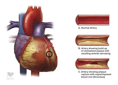 atherosclerotic aorta in tagalog|Coronary Heart Disease .